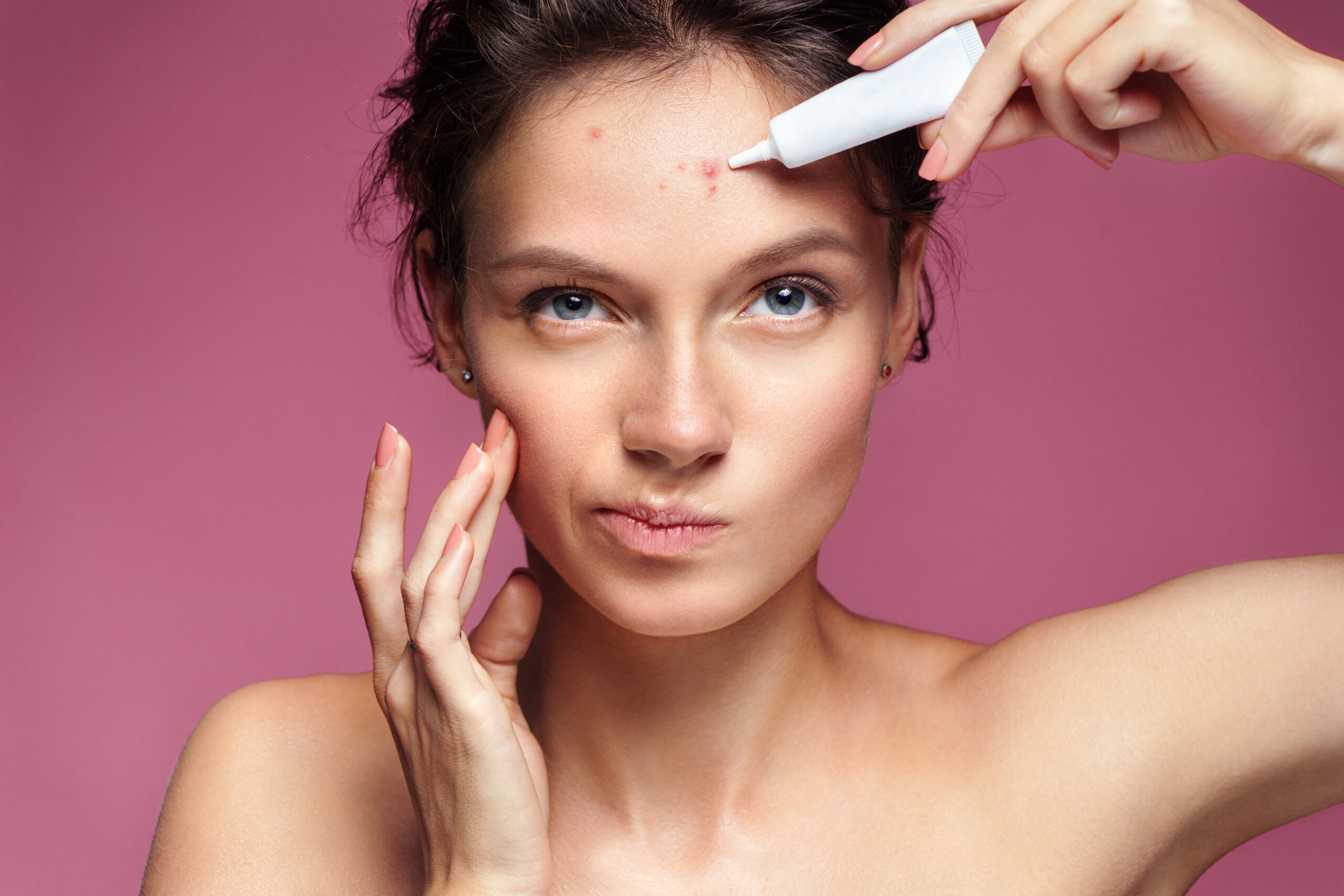 Person scowling and pointing at facial acne with white bottle